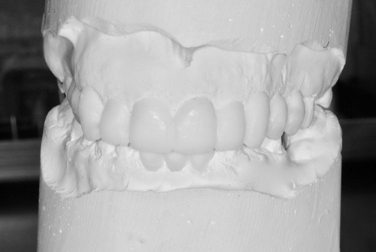 teeth mould